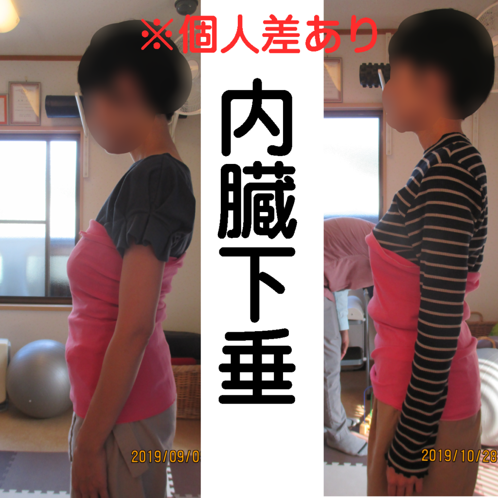 内臓下垂　改善