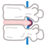 ヘルニアについて